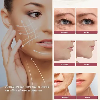 MZONG Radio Frequency Skin Care Device for Skin Wrinkles with Light Based, Radio